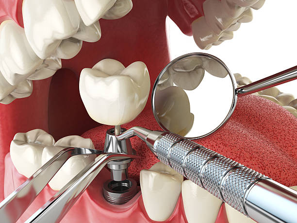 Best Emergency Root Canal Therapy in Tuckahoe, NY
